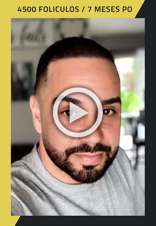 Vídeo del trasplante de cabello de 4500 foliculos siete meses después del procedimiento