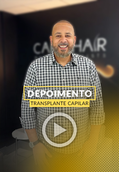 Depoimento de Charles transplante capilar.