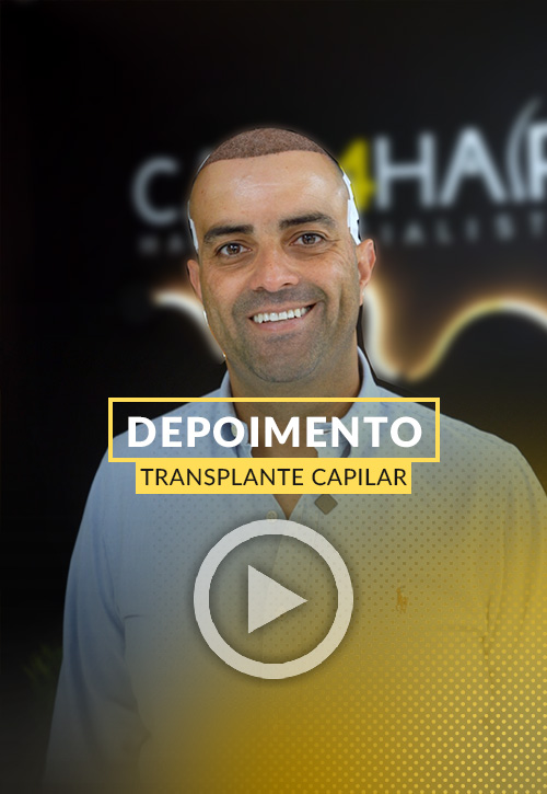 Depoimento de Sergio Ribeiro transplante capilar.