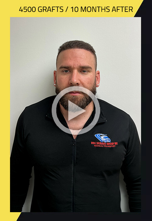 Hair Transplant before and after