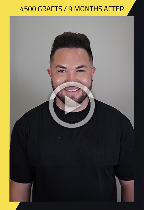 Hair Transplant before and after Rene