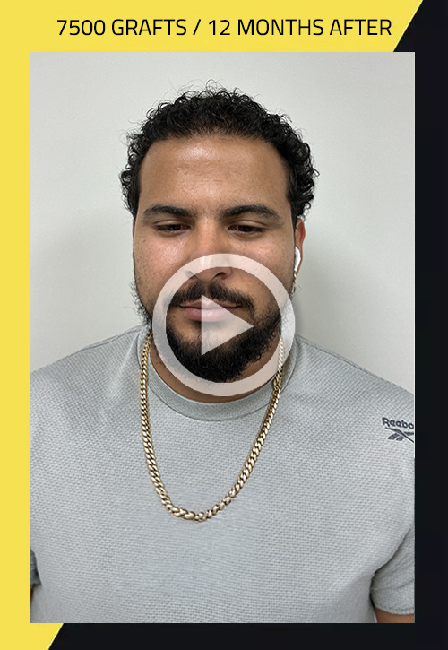 Hair Transplant before and after
