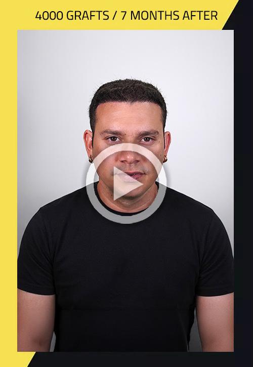 Hair Transplant before and after