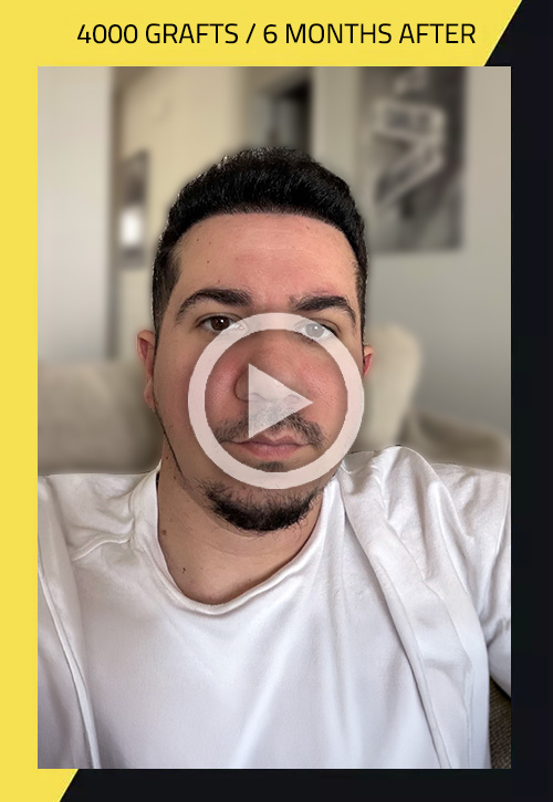 Hair Transplant before and after Carlos Ceballos