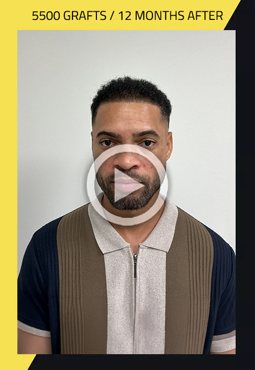 Hair Transplant before and after Juan figuerola