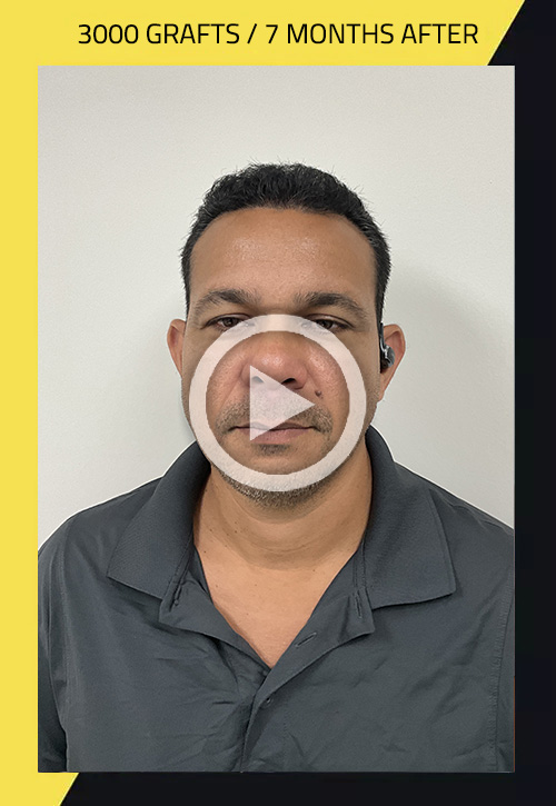Hair Transplant before and after Juan
