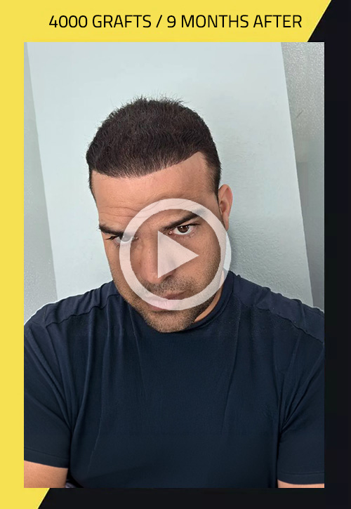 Hair Transplant before and after Lazaro Tellez 