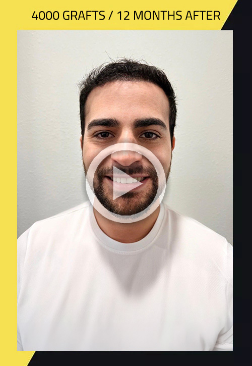 Hair Transplant before and after Reynerio