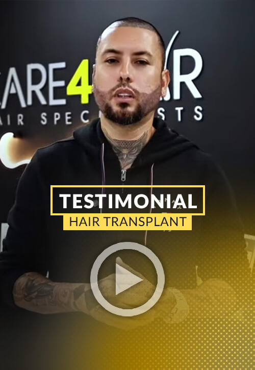 Hairline restoration and Beard Transplant in Miami
