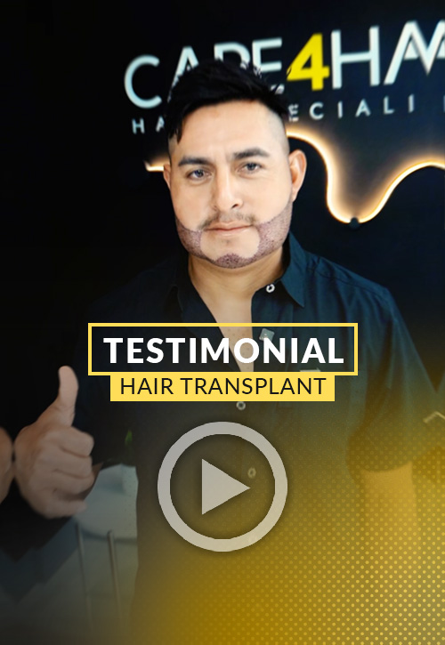 Mayco Velasquez Testimonial after his hair restoration in Miami | Care4Hair