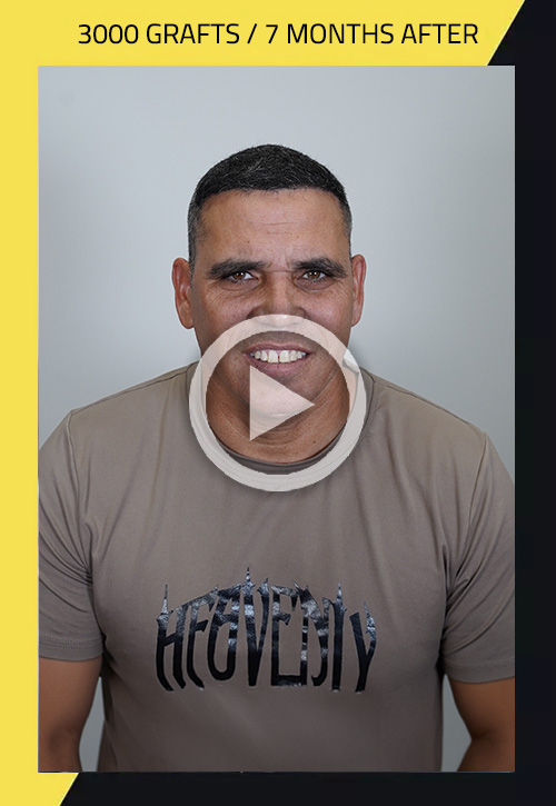 Hair Transplant before and after Yan Berta