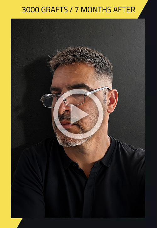 Hair Transplant before and after Yoan