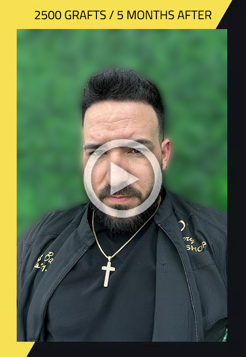 Hair Transplant before and after Yosuam
