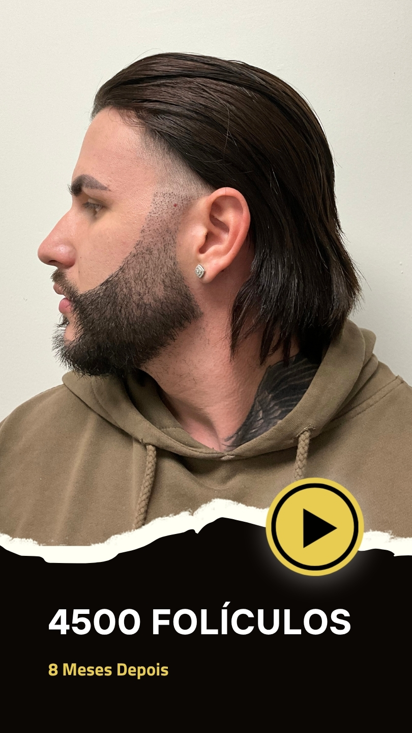 transplante de barba paciente dayron