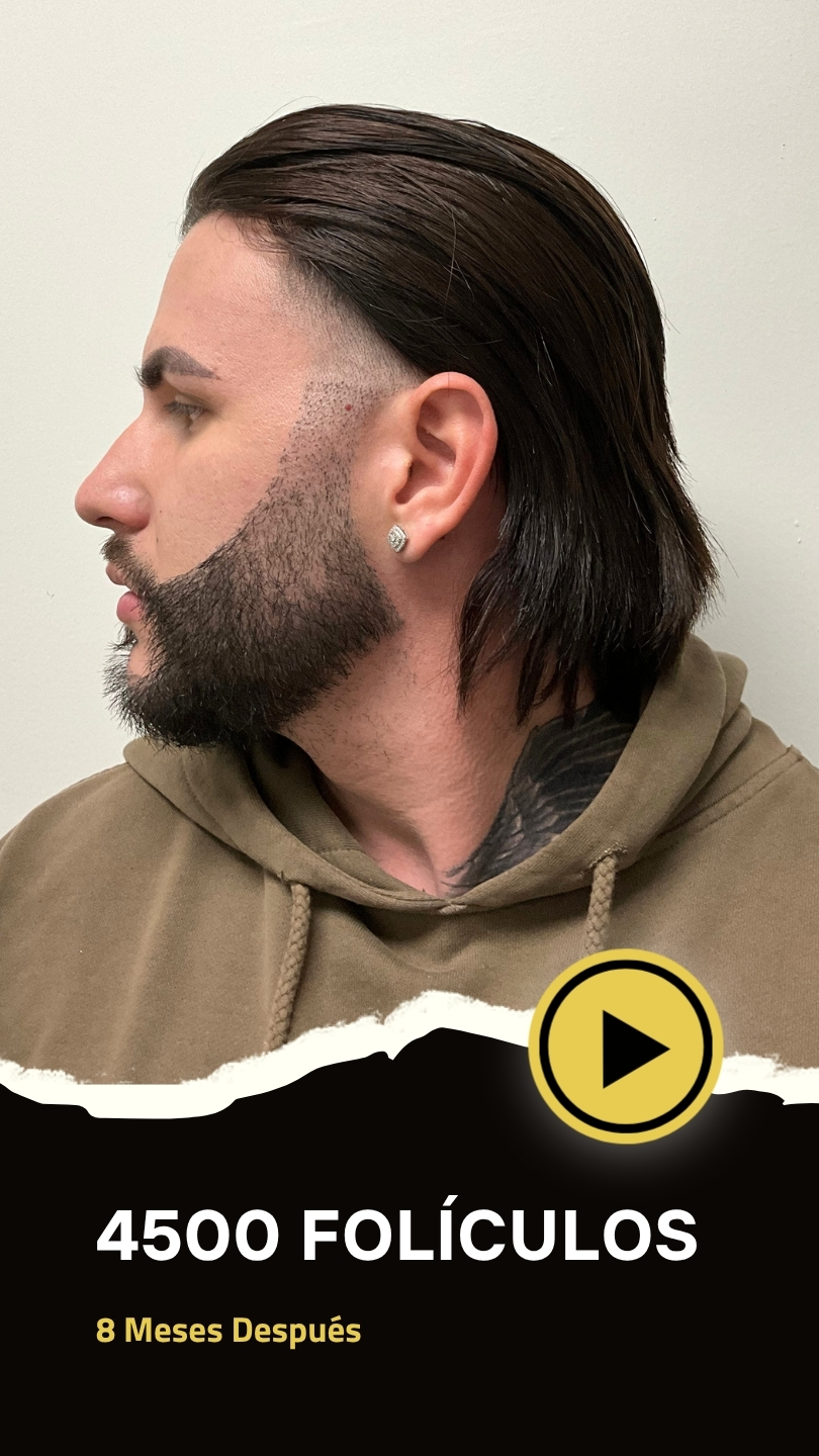 transplante de barba paciente dayron