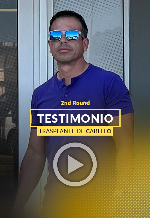 Video Testimonio de Paciente de Trasplante de Cabello con 5000 foliculos
