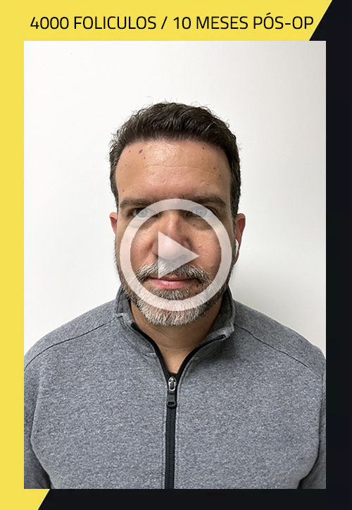 Transplante capilar antes e depois