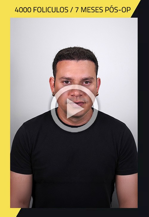 Transplante capilar: antes e depois