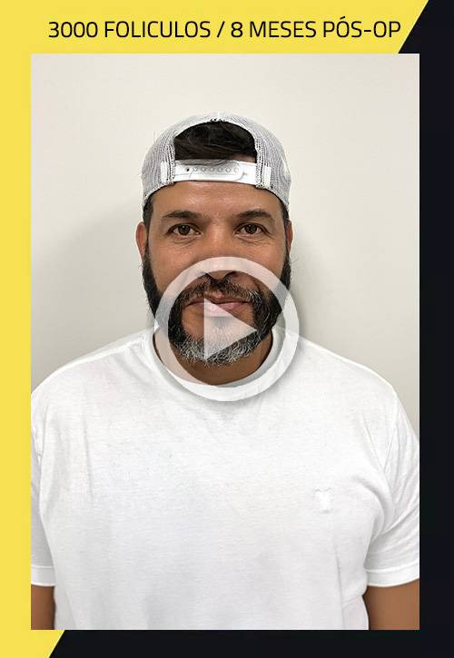 Beard Transplant before and after Alan Vela