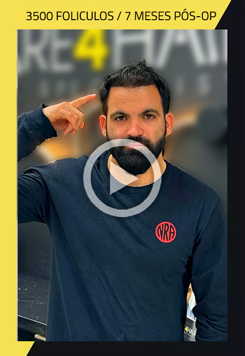 Hair Transplant before and after