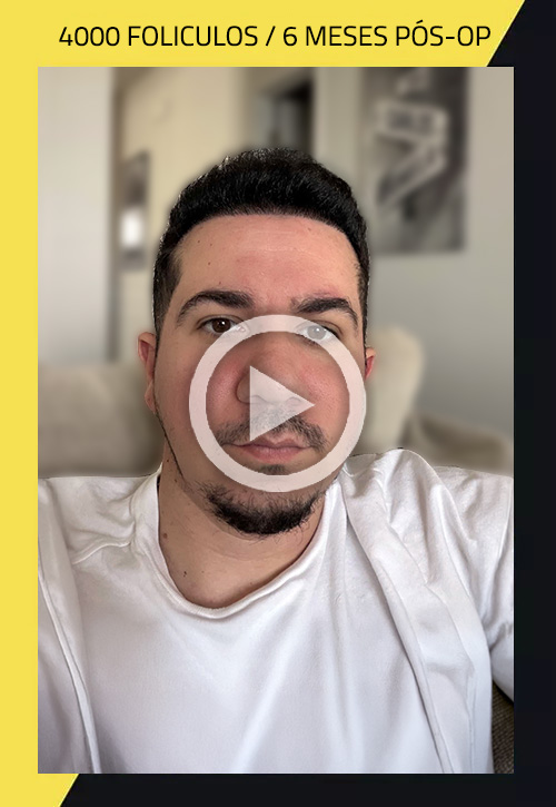 Hair Transplant before and after Carlos Ceballos