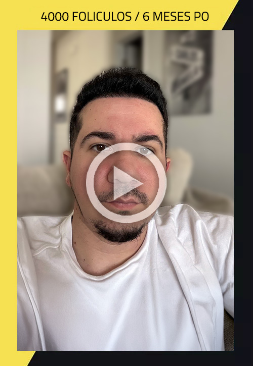 Hair Transplant before and after Carlos Ceballos