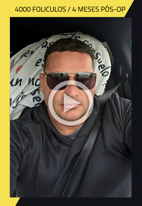 Hair Transplant before and after Heiner