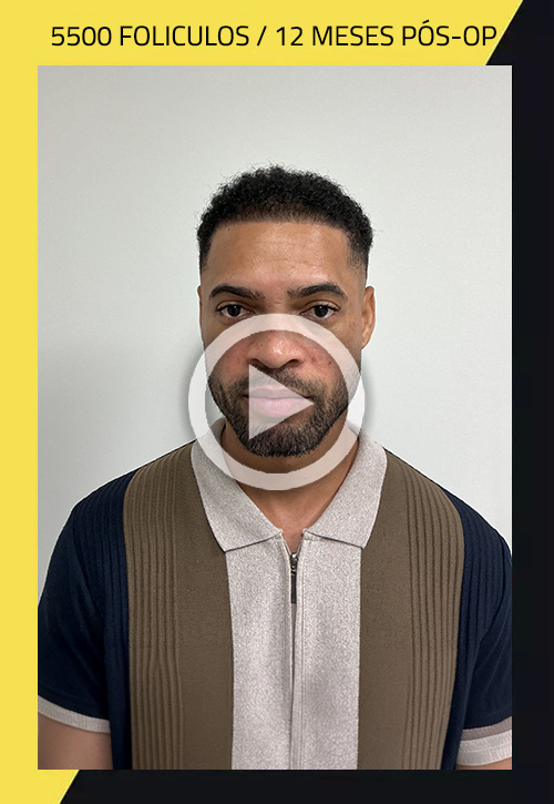 Hair Transplant before and after Juan figuerola