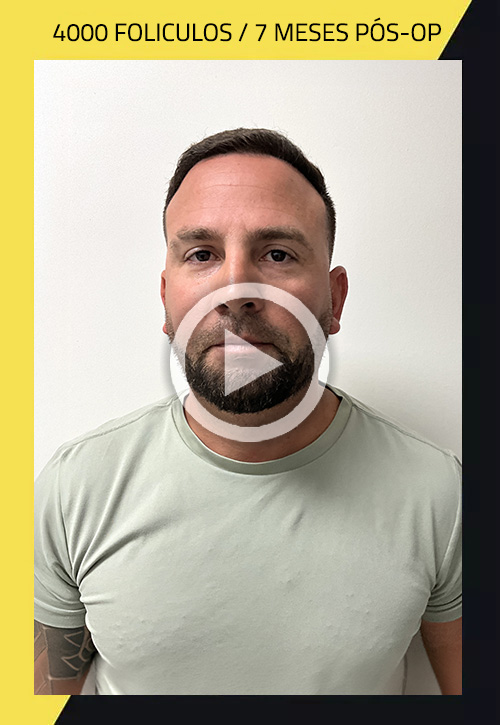 Hair Transplant before and after Odanis 