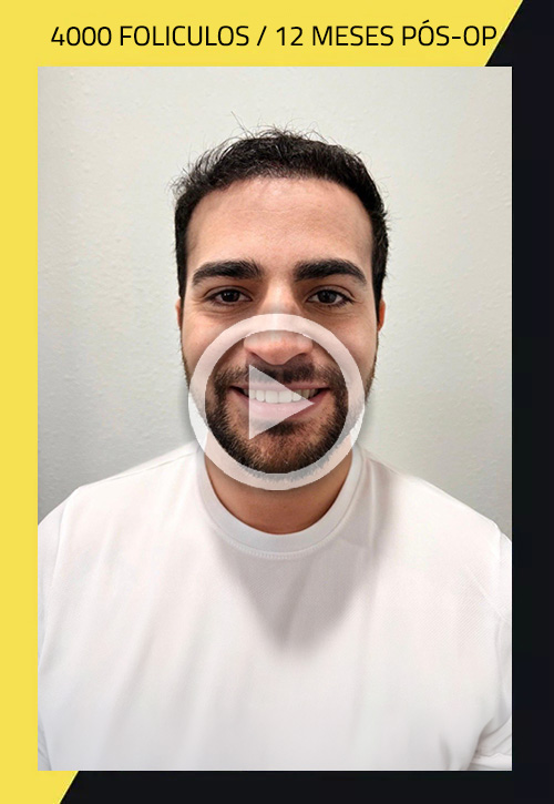 Hair Transplant before and after Reynerio
