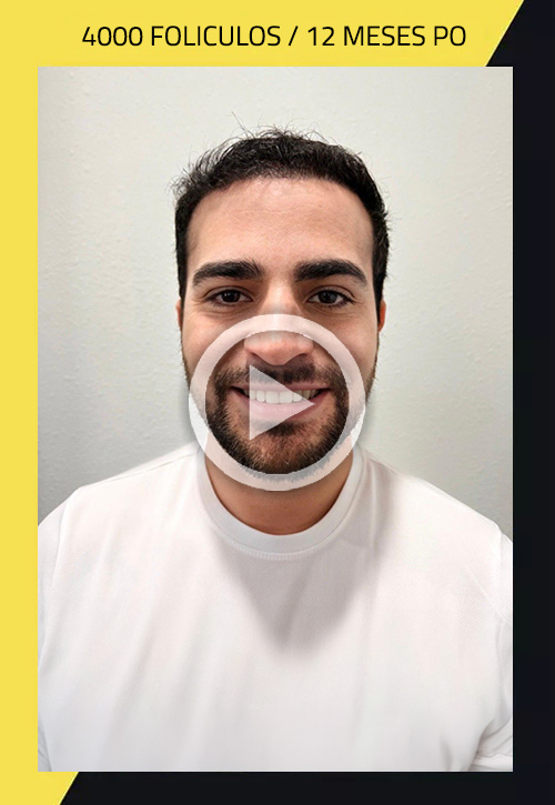 Hair Transplant before and after Reynerio