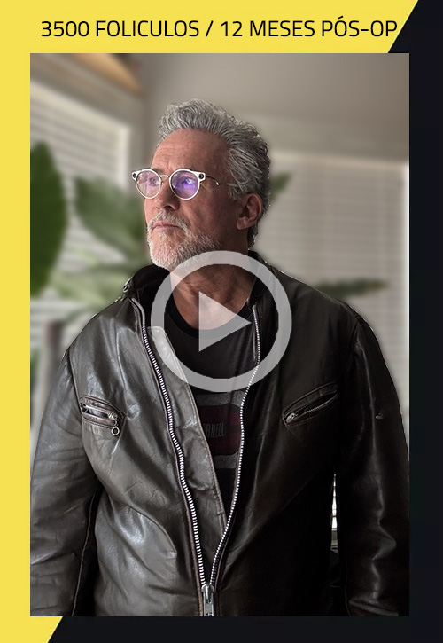 Hair Transplant before and after Richard 