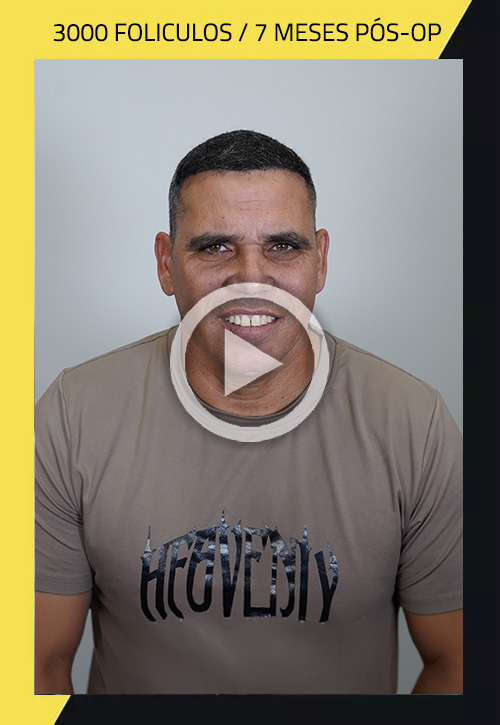 Hair Transplant before and after Yan Berta