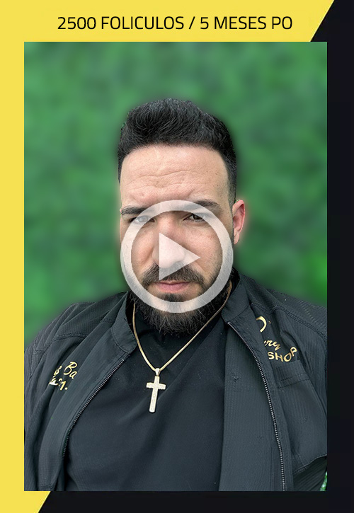 Hair Transplant before and after Yosuam