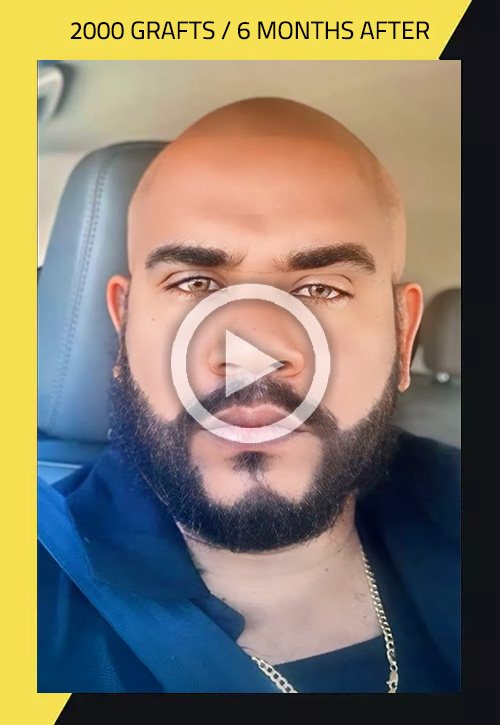 Transplante de cabello - paso a paso | Care4Hair