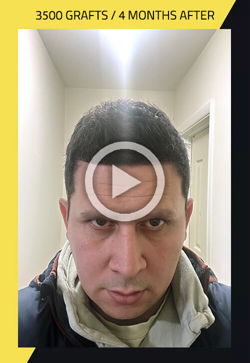 Transforming lives through the art of hair restoration.