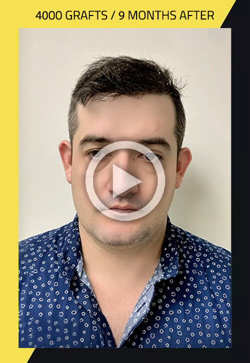 Hair Transplant? Hair Transformation?