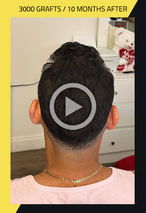 Reaction Before and After Hair Transplant