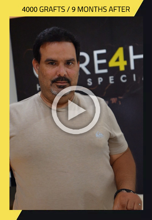 Hair Transplant in Care4Hair