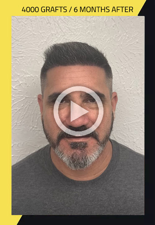 Hair Transplant, a simple procedure that can change your self-esteem Care4Hair 