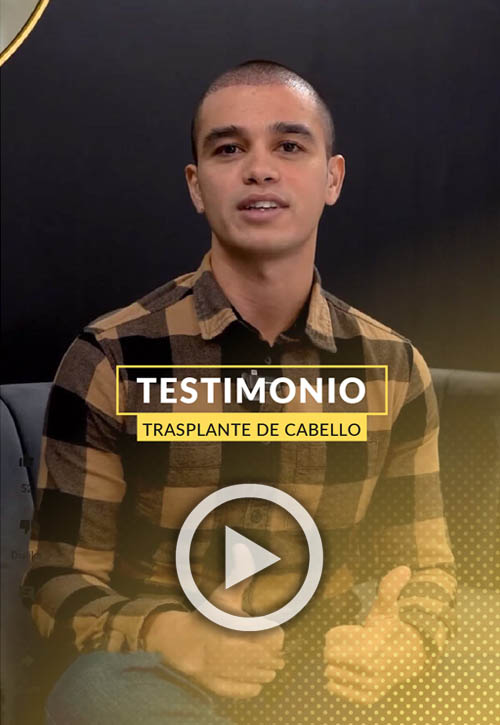 Testimonio de Injerto Capilar con 2000 foliculos 7 dias despues.